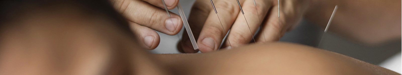 Acupuntura e Menopausa Alívio de Sintomas Sem Medicamentos